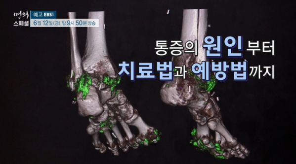 ▲'명의 스페셜' 통풍(사진제공=EBS1)