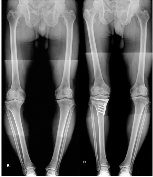 ▲심하게 변형된 오른쪽 다리(왼쪽), 카티스템으로 휜다리 교정술(high tibial osteotomy)을 통해 변형을 교정한 오른쪽 다리(오른쪽)

 (강남제이에스병원)