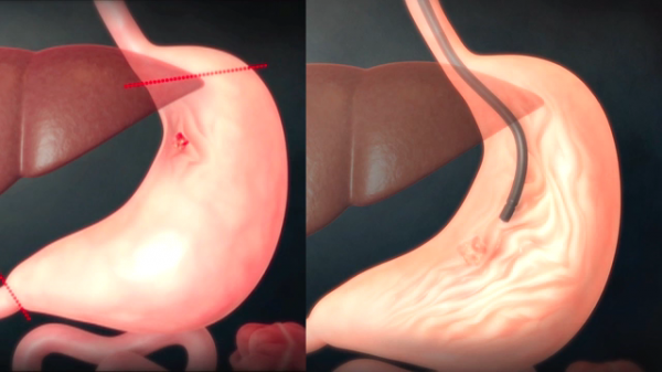 ▲'EBS 명의-위염과 조기위암' (사진제공=EBS1)