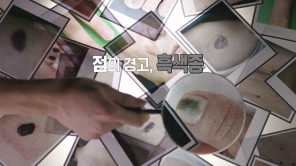 ▲EBS '명의' 흑색종(사진제공=EBS1)