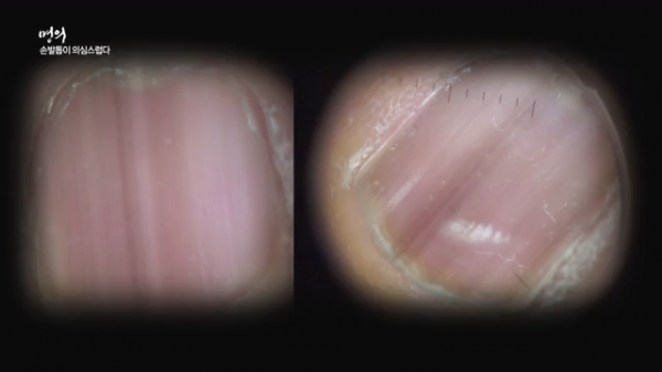 ▲EBS '명의' 흑색종(사진제공=EBS1)