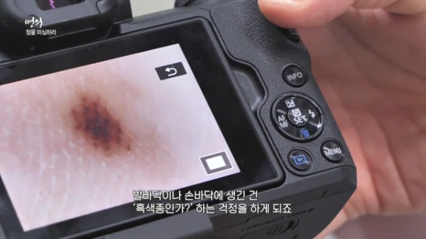 ▲EBS '명의' 흑색종(사진제공=EBS1)