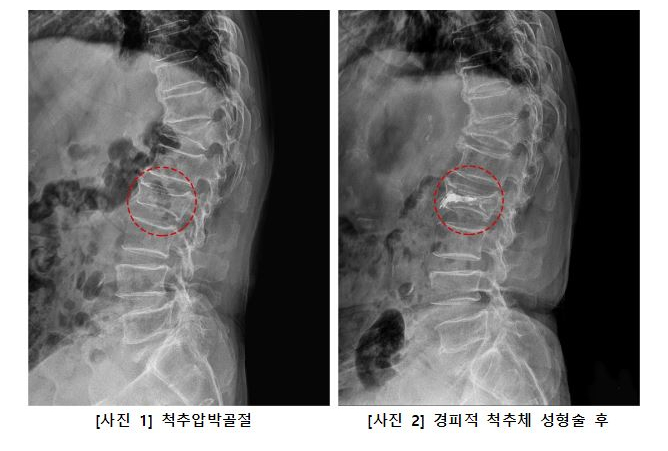 ▲사진 1. 척추압박골절, 외부 충격에 의해 척추뼈가 주저 앉거나 찌그러진 상태
사진 2. 경피적 척추체 성형술 후, 의료용 시멘트를 주입함으로써 골절된 척추의 안정성을 보강


 (사진제공=이춘택병원)