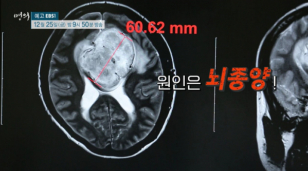 ▲EBS '명의' 뇌종양(사진제공=EBS1)