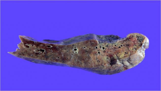 ▲지난달 21일 신종 코로나바이러스 감염증(코로나19)로 폐 섬유화가 진행된 50대 여성 환자에게 폐를 이식하는 수술에 성공했다고 한림대학교 성심병원이 2일 밝혔다(사진=연합뉴스)