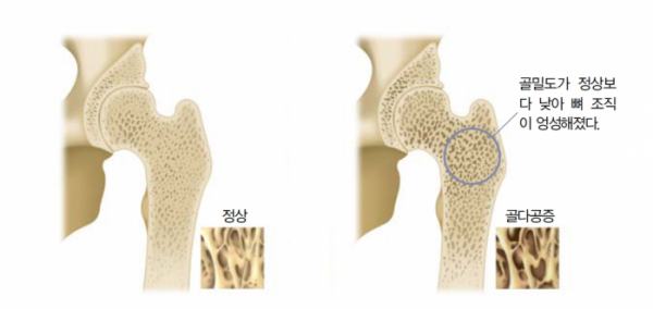 ▲정상 뼈(왼쪽)와 골다공증이 있는 뼈(오른쪽)