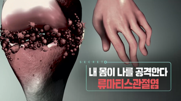 ▲'생로병사의 비밀' 류마티스관절염(사진제공=KBS 1TV)