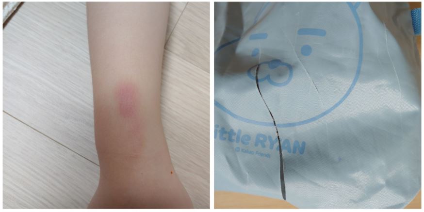 ▲경북 문경 A 유치원에서 학대받은 아동의 부모라고 주장한 사람이 올린 사진. 아이 팔에 상처가 나 있고 가방도 찢어져있다. (출처=인터넷 커뮤니티 캡처)