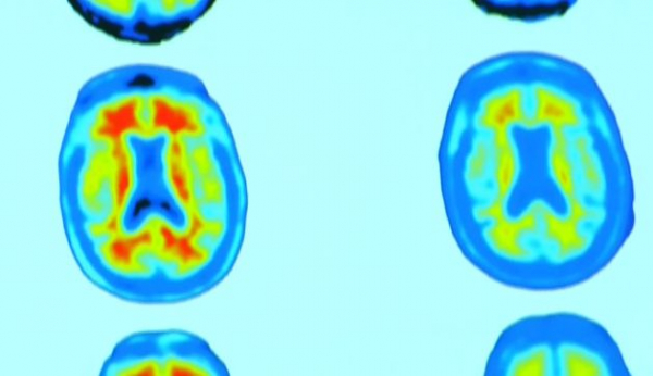 ▲알츠하이머 치매 환자의 뇌양전자 방출 단층촬영(PET) 영상이다. 왼쪽에서 붉게 보이는 부분이 베타 아밀로이드로, 치료제를 투입하자 오른쪽처럼 사라졌다.