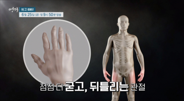 ▲'명의' 류마티스 관절염(사진제공=EBS1)