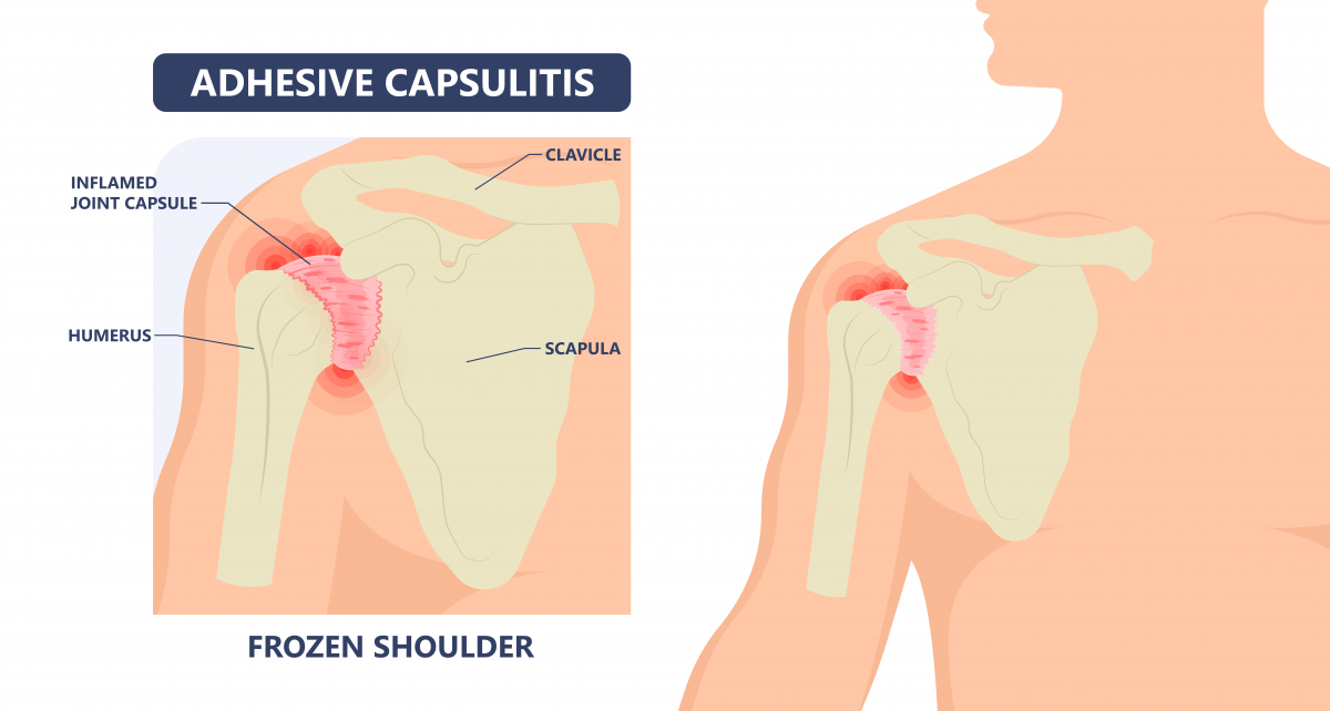 ▲유착성 관절낭염(adhesive capsulitis)
