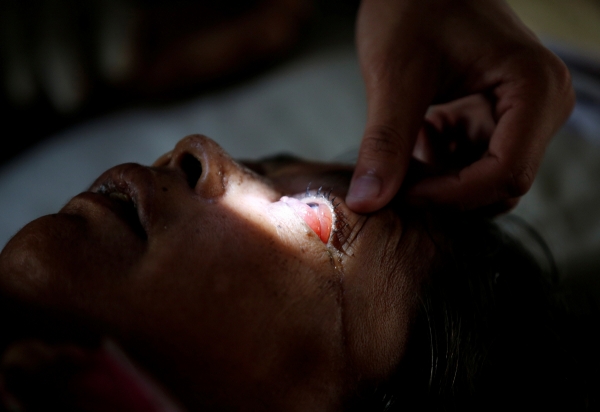 ▲의사가 6월 28일 인도 아마다바드의 한 병원에서 털곰팡이증을 앓고 있는 환자의 눈을 검사하고 있다. 아마다바드/로이터연합뉴스
