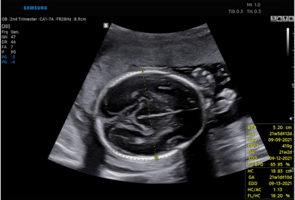 ▲태아 초음파 이미지에서 바이오메트리 솔루션을 활용하여 태아의 머리를 자동으로 인지 및 측정해 태아의 성장 정도를 보여주는 화면 (사진제공=삼성메디슨)
