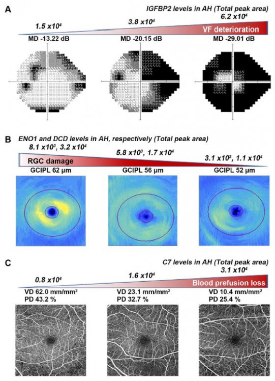 ▲지용우 교수팀은 정상안압 녹내장 환자에서 각각의 방수 바이오마커 발현이 시야 손상(VF deterioration), 망막시신경세포 손상(RGC damage), 망막혈류 감소(Blood prefusion loss) 등의 진행과 밀접한 관계가 있음을 확인했다. (AH: 방수, GCIPL: 망막시신경세포층, VD: 망막혈관밀도, PD: 망막혈관관류) (사진제공=용인세브란스병원)
