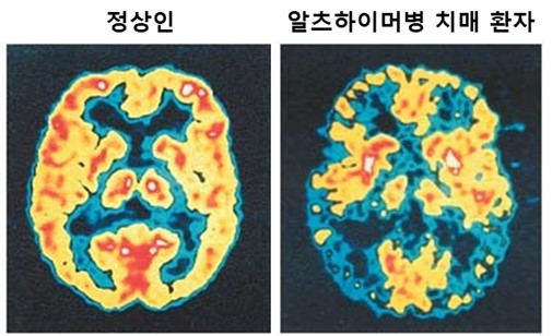 ▲양전자방출단층촬영술(positron emission tomography: PET)을 통해 정상인 및 알츠하이머병 치매환자의 뇌를 비교한 자료 (사진제공=셀리버리)