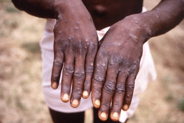 ▲원숭이두창에 감염된 환자의 손에 발진이 발생해 있는 모습. 사진은 콩고민주공화국에서 원숭이두창이 발발했던 1996~1997년에 촬영됐다. AP뉴시스
