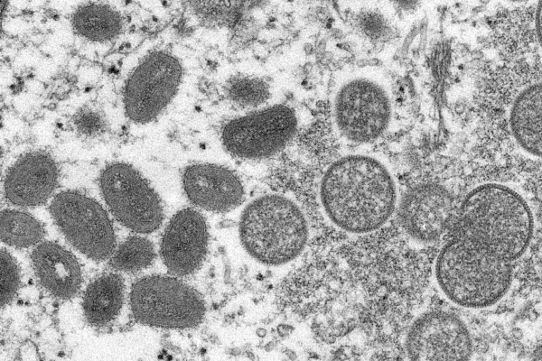 ▲미국 질병통제예방센터(CDC)가 공개한 전자현미경 사진. 2003년 인간의 피부 샘플에서 얻은 원숭이두창 바이러스. 타원형(왼쪽)은 성숙된, 구형은 미성숙 바이러스다. AP연합뉴스
