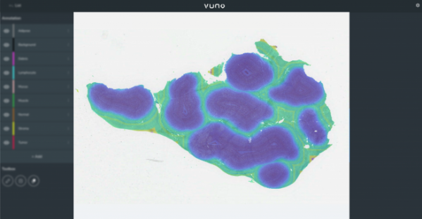 ▲뷰노의 AI 기반 병리 연구 플랫폼 뷰노메드 패스랩™에서 간암 병리 슬라이드에 대한 공간분석 결과 (제공=뷰노)