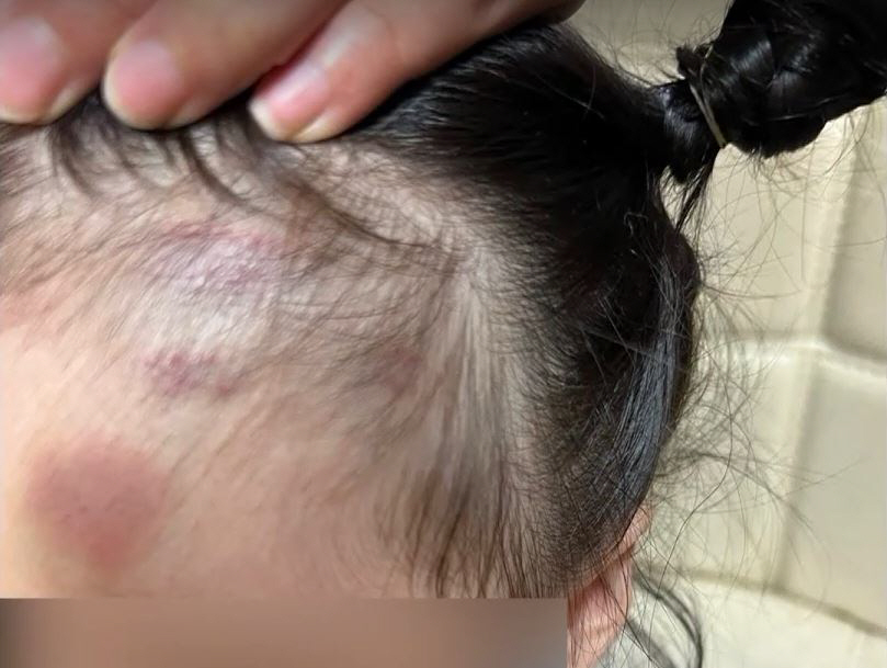 ▲피해 아동 상처 모습. (출처=SBS 보도화면 캡처)
