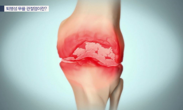 ▲'명의' 무릎(사진제공=EBS1)