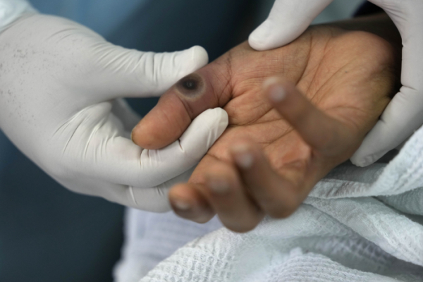 ▲16일(현지시간) 페루 리마 한 병원에서 의료진이 원숭이두창 감염 환자의 손을 살펴보고 있다. 리마/AP뉴시스 