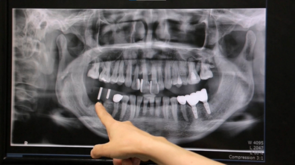 ▲'명의' 치주염(사진제공=EBS1)