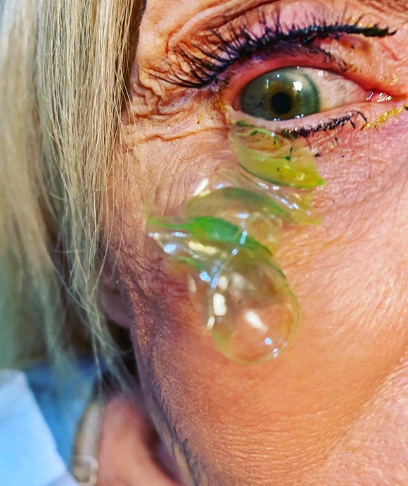▲캘리포니아의 한 안과의가 공개한 사진. 눈에서 23개의 콘택트렌즈가 나왔다.  (출처=카테리나 쿠르테바 인스타그램)