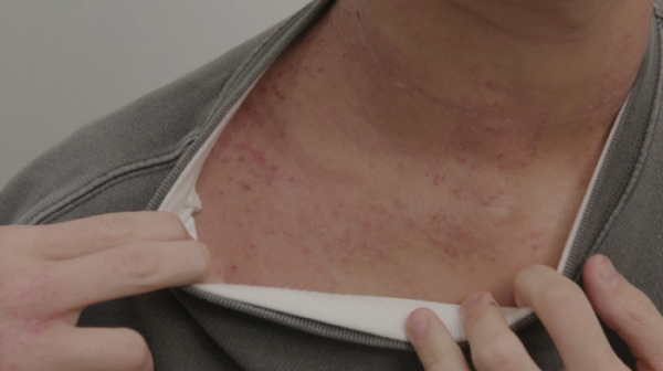 ▲'명의' 소아아토피(사진제공=EBS1)