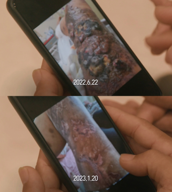 ▲'생로병사의비밀' 혈액암(사진제공=KBS 1TV)