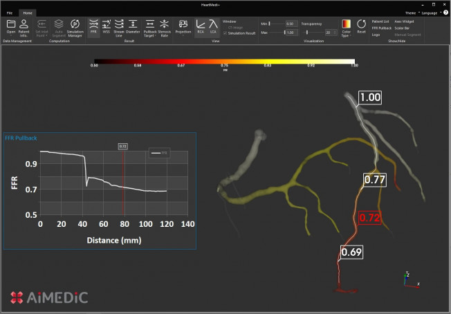 ▲에이아이메딕의 하트메디플러스 FFR 측정 결과 (사진제공=에이아이메딕)