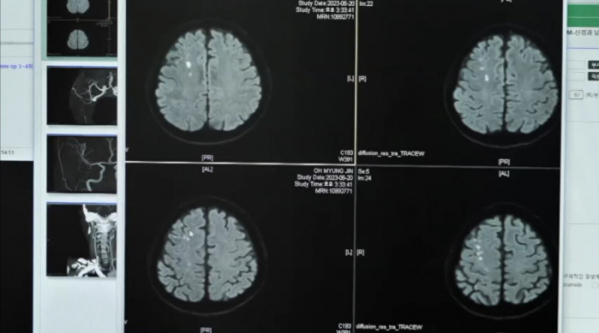 ▲'명의' 여름 뇌졸증(사진제공=EBS1)