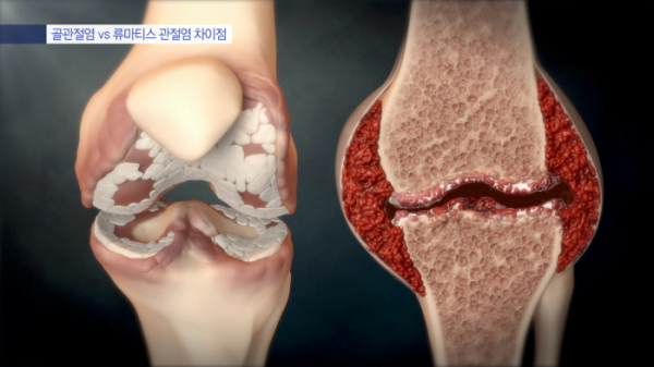 ▲'명의' 류마티스 관절염(사진제공=EBS1)