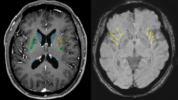 ▲이식 전(왼쪽)·후(오른쪽) MRI, 이식 후 MRI에서 성공적으로 세포가 이식된 부위를 확인할 수 있다.(화살표) (사진제공=세브란스병원)