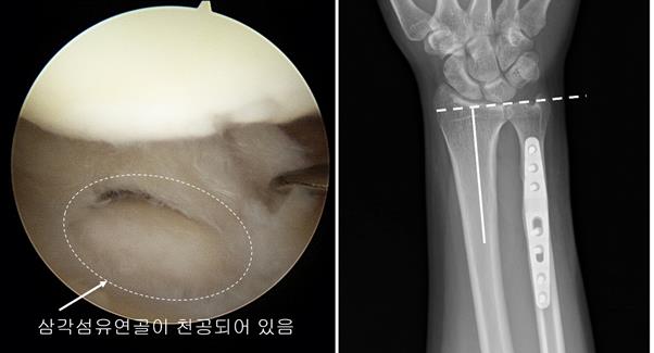 ▲같은 환자의 관절경 소견상 좌측 그림과 같이 삼각섬유연골이 마모되어 가운데 구멍이 나 있고 우측 그림은 척골단축술 후 요골과 척골의 길이가 같아진 것을 볼 수 있다. (사진제공=중앙대학교병)