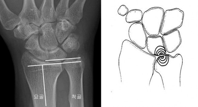 ▲좌측의 그림처럼 손목에서 척골의 길이가 요골보다 긴 경우, 우측의 그림처럼 척골과 수근골 사이에 충돌이 일어나는 상태를 ‘척골충돌증후군’이라고 한다.  (사진제공=중앙대학교병원)
