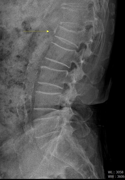 ▲﻿추압박골절 환자의 엑스레이 영상. 화살표 부위의 척추뼈가 눌려져 있다. (사진제공=﻿서울예스병원)