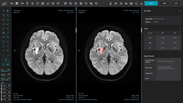 ▲제이엘케이의 AI 뇌경색 진단 소프트웨어 JBS-01K 구동 화면. (사진제공=제이엘케이)