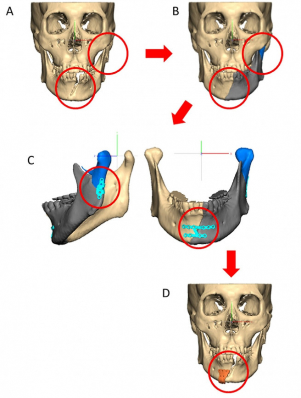 ▲환자 맞춤형 안골절수술 모식도=(A)환자의 CT를 3차원적으로 재구성 (B)가상 수술로 골절편을 재위치로 정복한 모습 (C)환자 맞춤형 금속판 디자인 (D)환자 맞춤형 수술 가이드 디자인 (제공=한림대성심병원)