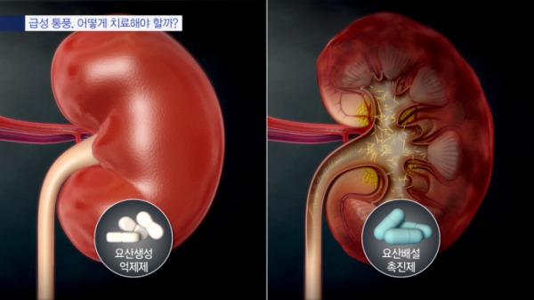 ▲'명의' 통풍(사진제공=EBS1)