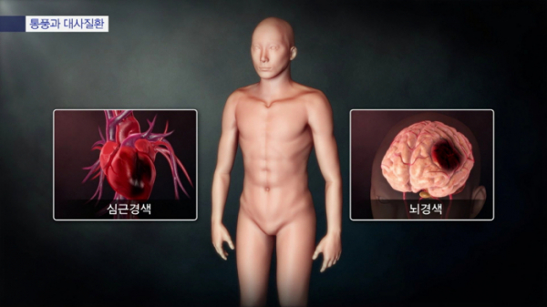 ▲'명의' 통풍(사진제공=EBS1)