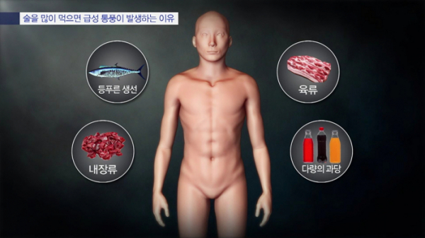 ▲'명의' 통풍(사진제공=EBS1)