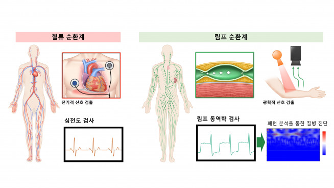 ▲심전도 검사와 림프 동역학 검사 비교 (사진제공=서울아산병원)