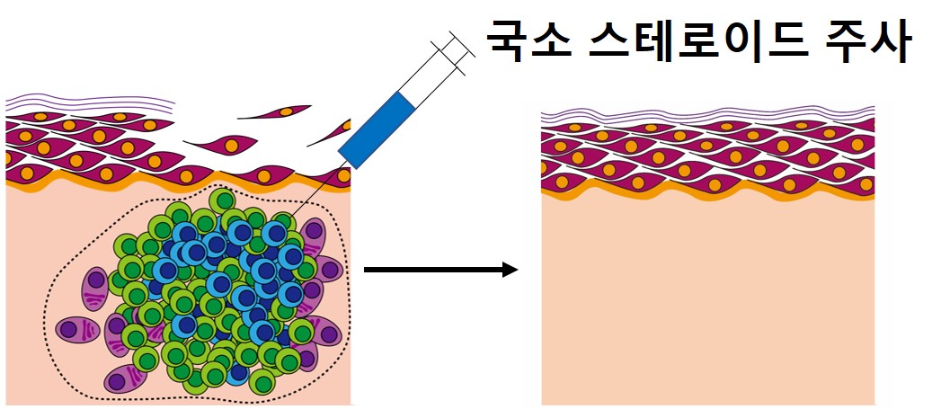 ▲만성 재발성 천포창에 국소 스테로이드 주사 치료를 하기 전, 후 피부 병변의 변화 (제공=강남세브란스병원)