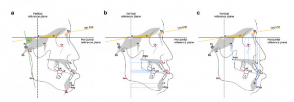 ▲측모 두부계측방사선 사진(Lateral cephalogram)의 랜드마크와 길이, 각도 변수들 (사진제공=아주대병원)