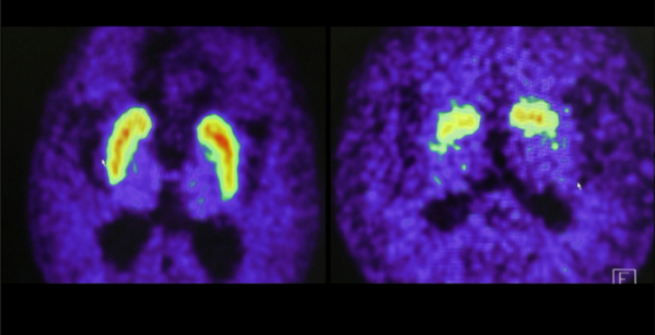 ▲'명의' 파킨슨병(사진제공=EBS1)