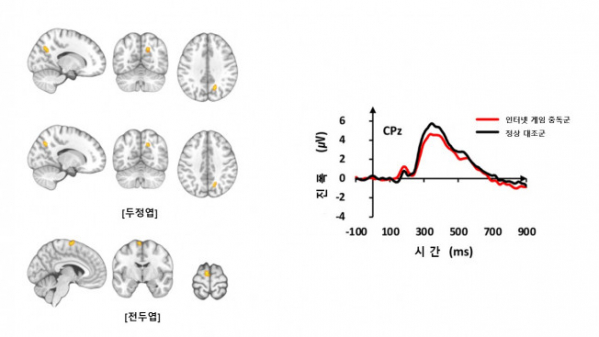 ▲(왼쪽 사진) 기능적 MRI 검사 결과 인터넷 게임 중독군은 정상대조군들보다 두정엽과 전두엽 부위에서 뇌 활성이 증가했다. (오른쪽 그래프) 청각 자극에 대한 뇌파 신호의 진폭은 인터넷 게임 중독군이 정상대조군보다 감소했다.   (사진제공=삼성서울병원)