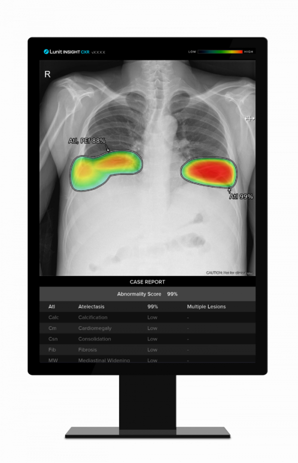 ▲루닛 흉부 엑스레이 AI 영상분석 솔루션 '루닛 인사이트 CXR' (사진제공=루닛)