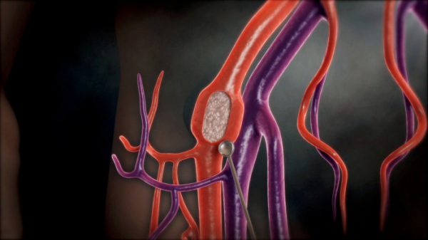 ▲'명의' 혈관 (사진제공=EBS1)