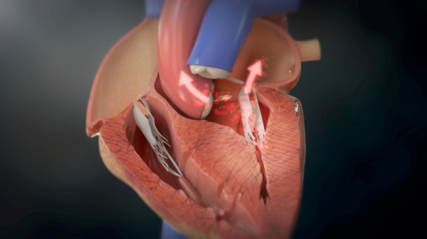 ▲'명의' 심근병증 (사진제공=EBS1)