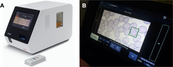 ▲마이랩 디바이스와 카트리지(왼쪽)를 통해 분석한 기생충 감염 적혈구를 기기 화면에서 직접 볼 수 있다 (사진제공=노을)